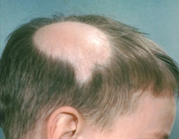 Alopecia areata 