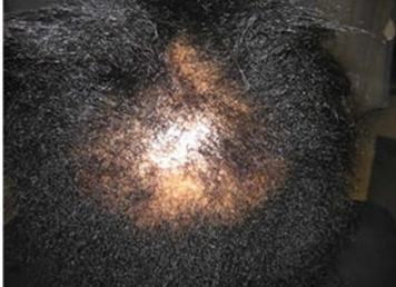 Central centrifugal cicatrical alopecia