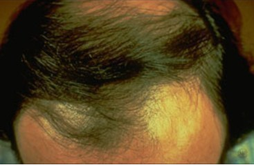 Androgenetic alopecia (male pattern baldness)