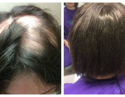 thinning hair women - before and after