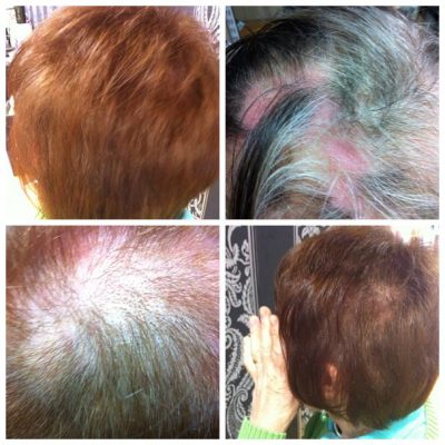 hair thinning treatment Ribí Clinic