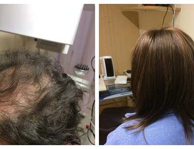hair loss in women-hair loss treatment