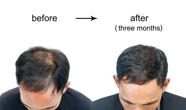 male hair loss treatment