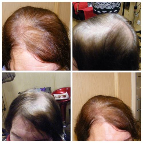 laser1 hair thinning at crown female