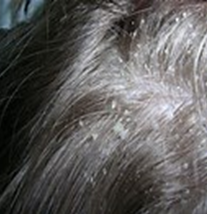 Dry scaly scalp