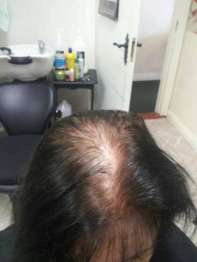 Female pattern hairloss