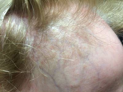 Frontal fibrosing alopecia