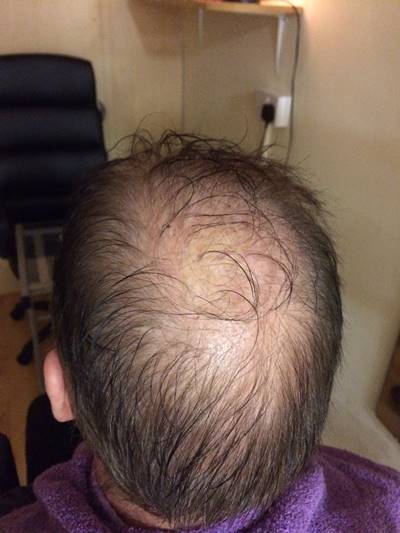 Male pattern hair loss