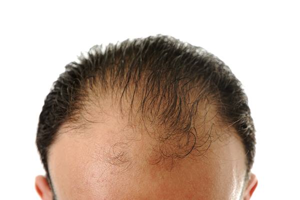 Hair loss is distressing but help is available - Ribi Trichology Clinic
