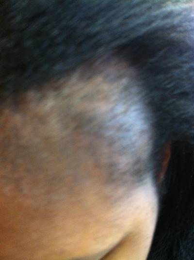 Traction alopecia